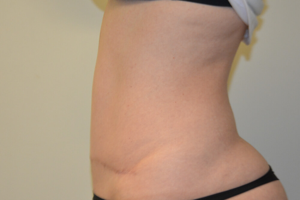 Tummy-Tuck-30 | After Tummy Tuck 5