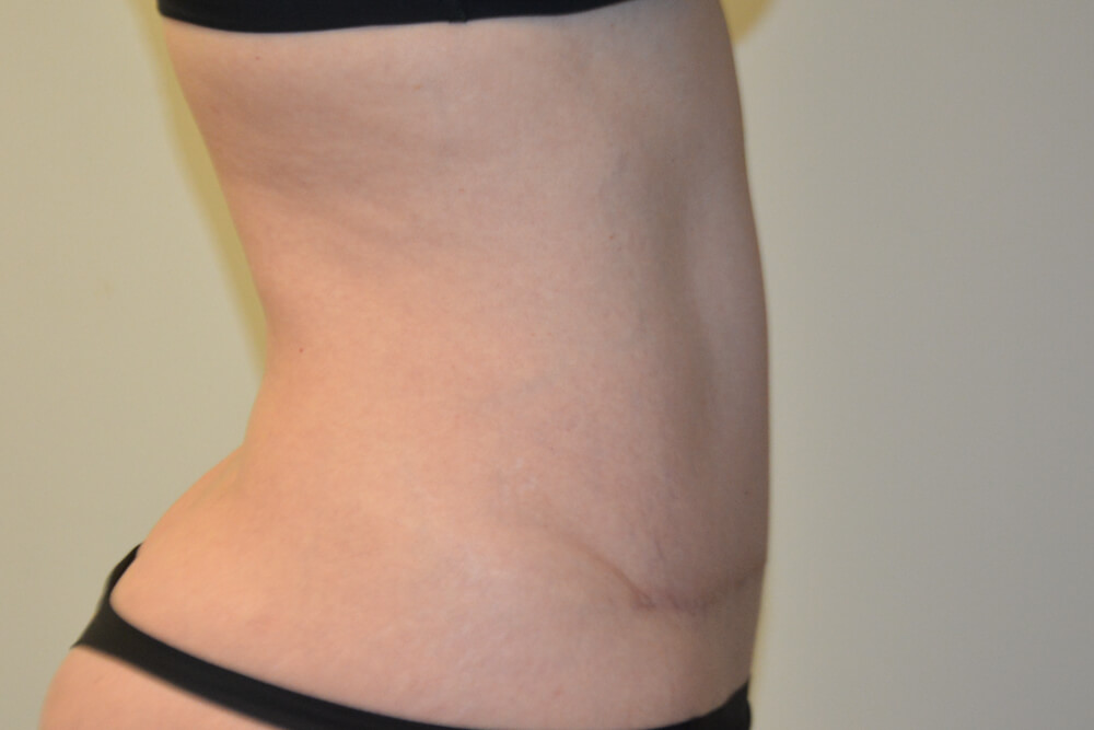 Tummy-Tuck-30 | After Tummy Tuck 3