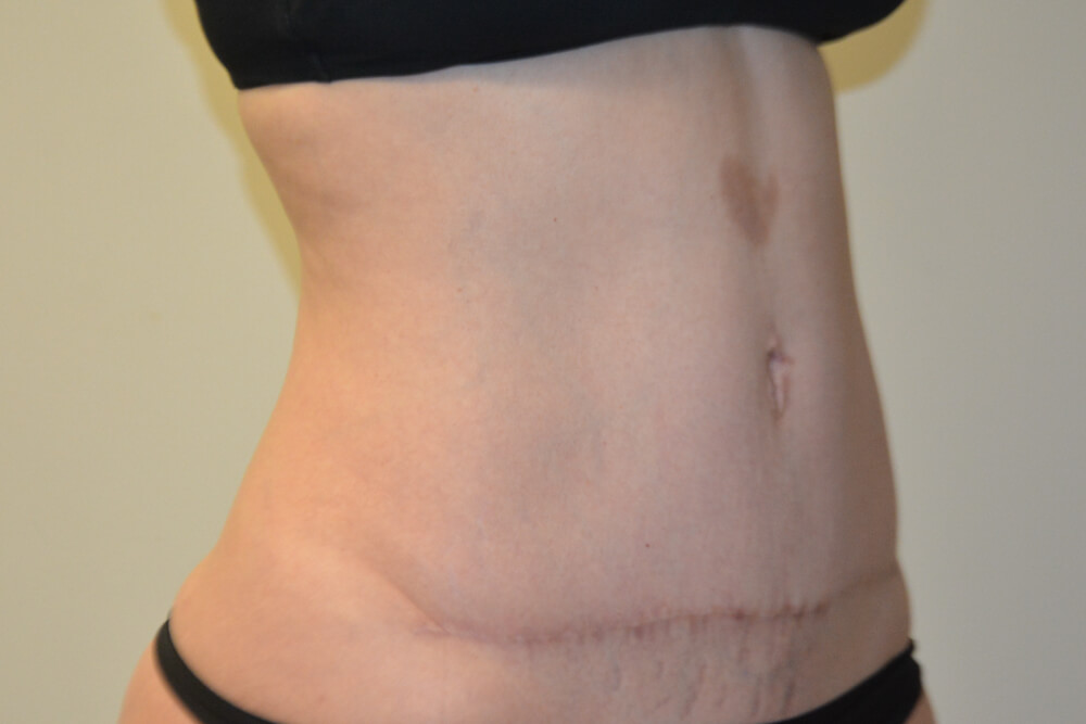 Tummy-Tuck-30 | After Tummy Tuck 2