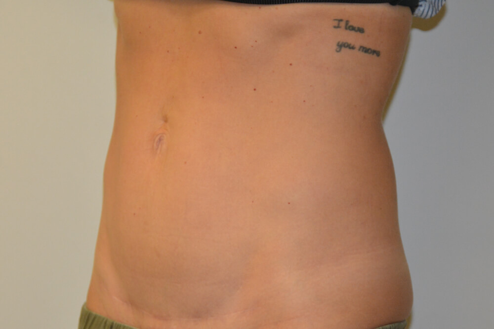 Mini-Tummy-Tuck-09 | After Mini Tummy Tuck 4