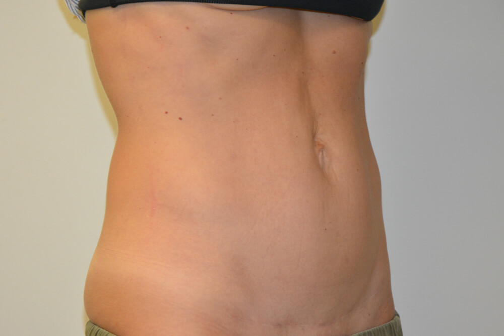 Mini-Tummy-Tuck-09 | After Mini Tummy Tuck 2