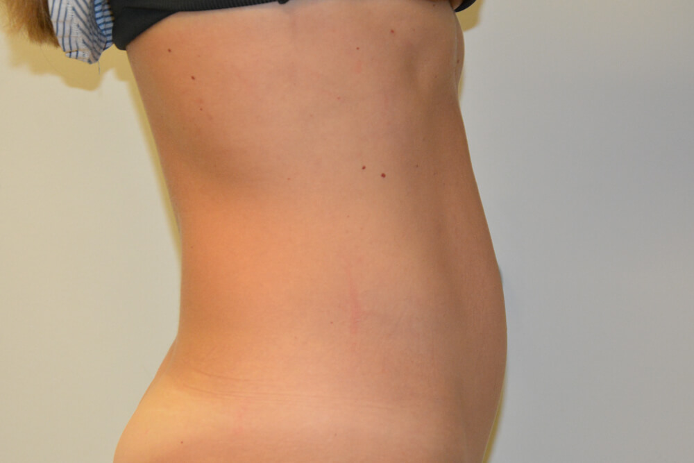Mini-Tummy-Tuck-09 | After Mini Tummy Tuck 3