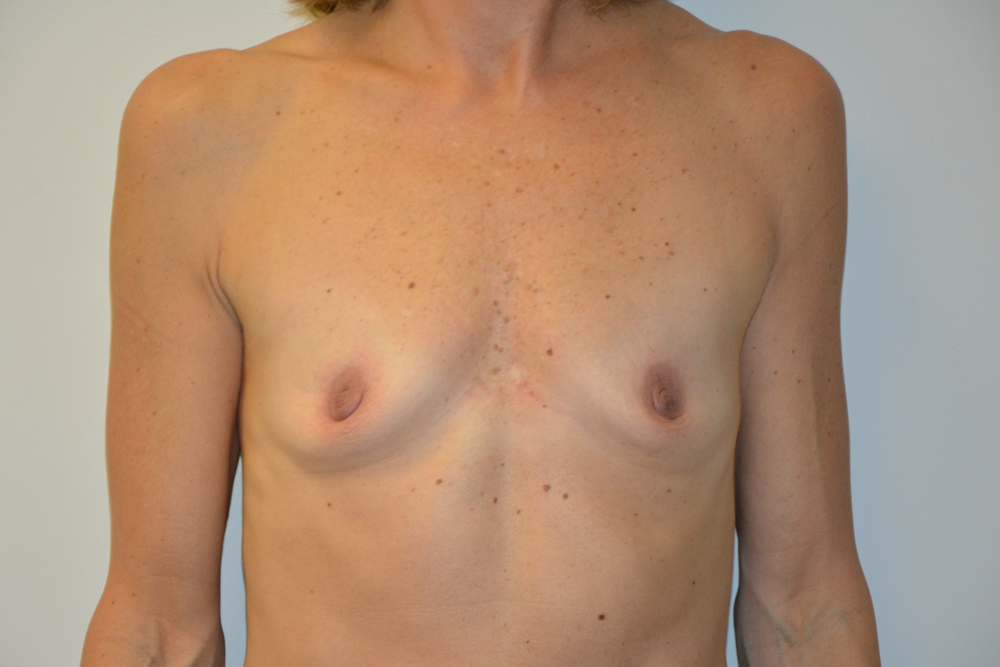 Breast-Augmentation-26 | Before Breast Augmentation