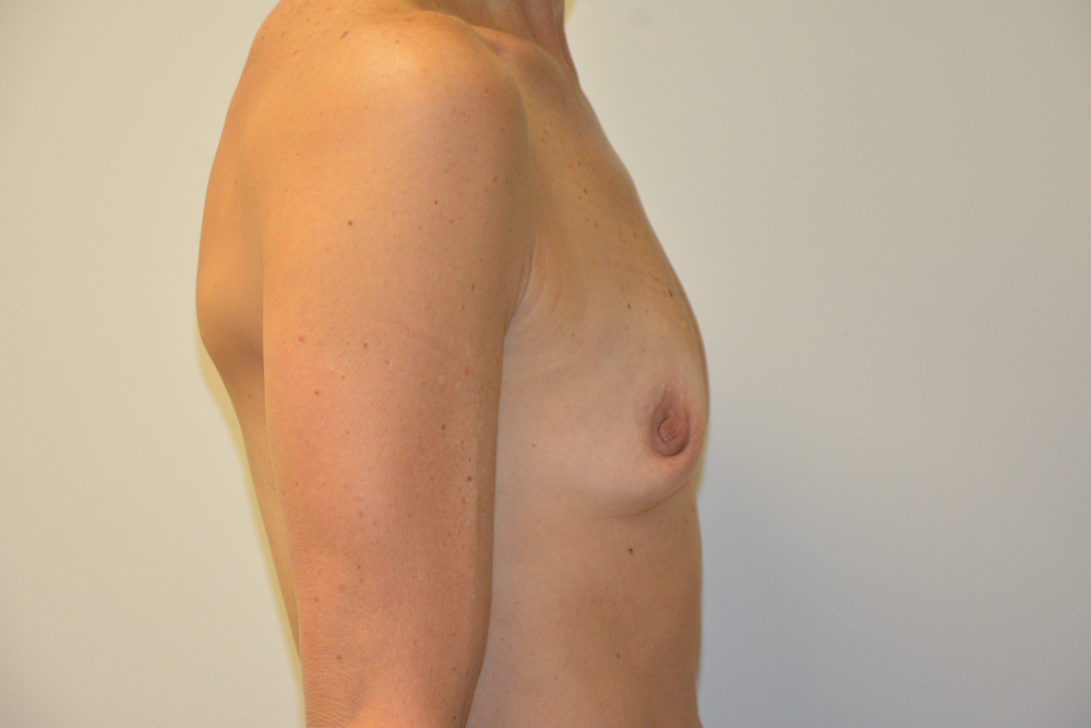 Breast-Augmentation-26 | Before Breast Augmentation 5