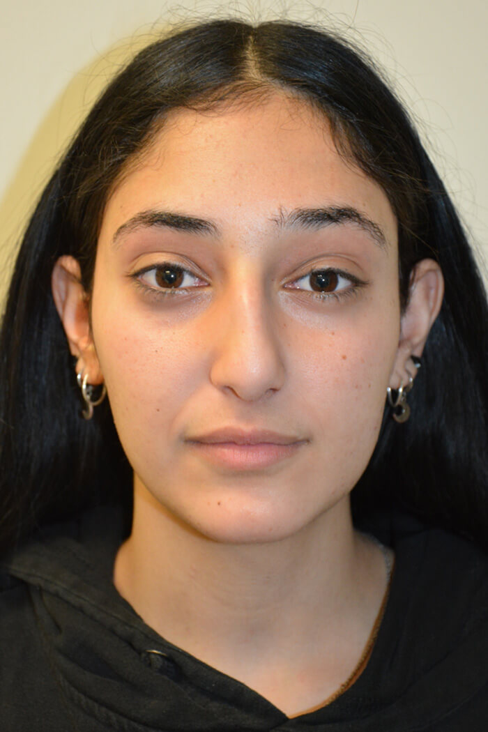 Rhinoplasty-12 | Before Rhinoplasty 5