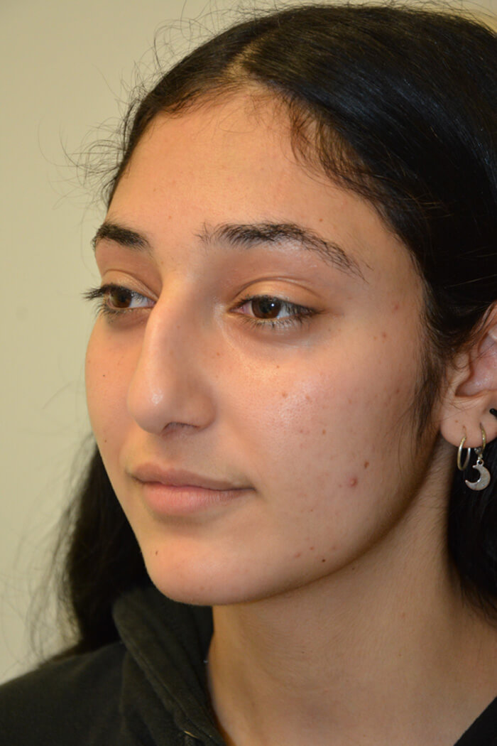 Rhinoplasty-12 | Before Rhinoplasty 4