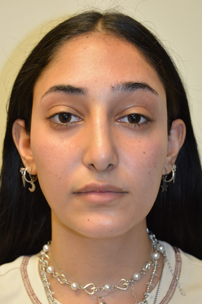 Rhinoplasty-12 | After Rhinoplasty 5