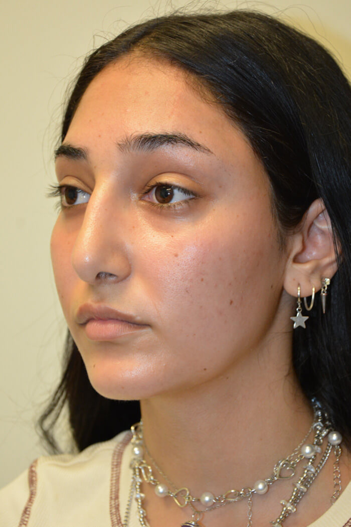 Rhinoplasty-12 | After Rhinoplasty 4