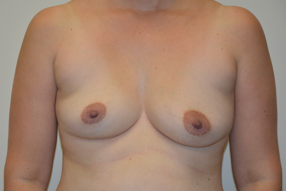 Breast-Augmentation-20 | Before Breast Augmentation