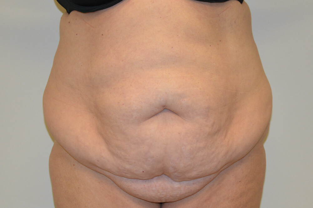 Tummy-Tuck-20 | Before Tummy Tuck