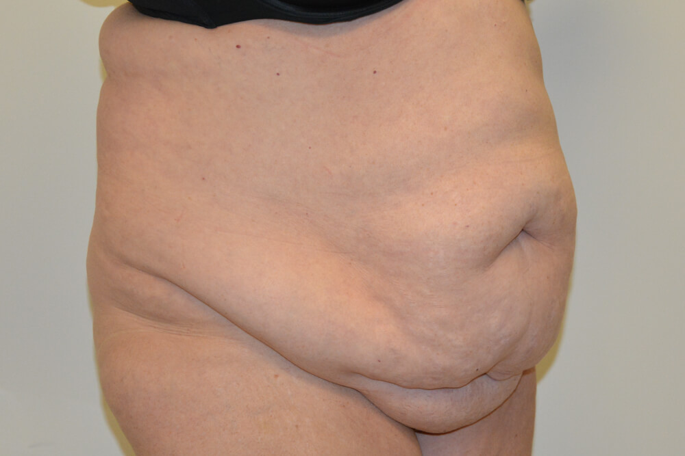Tummy-Tuck-20 | Before Tummy Tuck 2