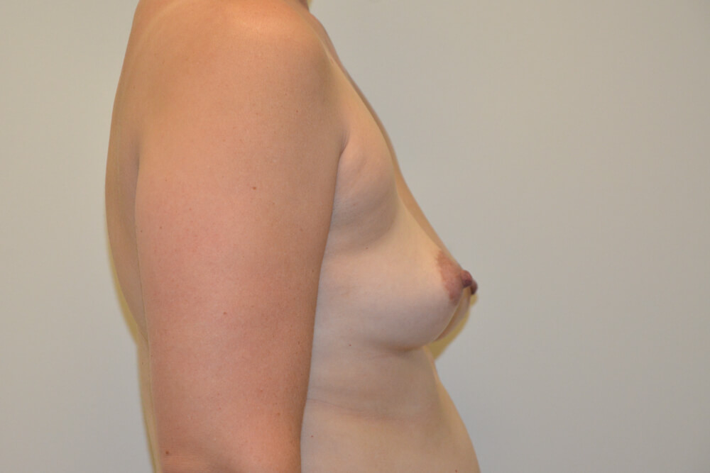 Breast-Augmentation-20 | Before Breast Augmentation 3