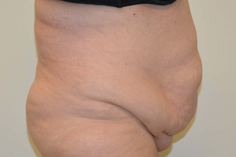 Tummy-Tuck-20 | Before Tummy Tuck 3