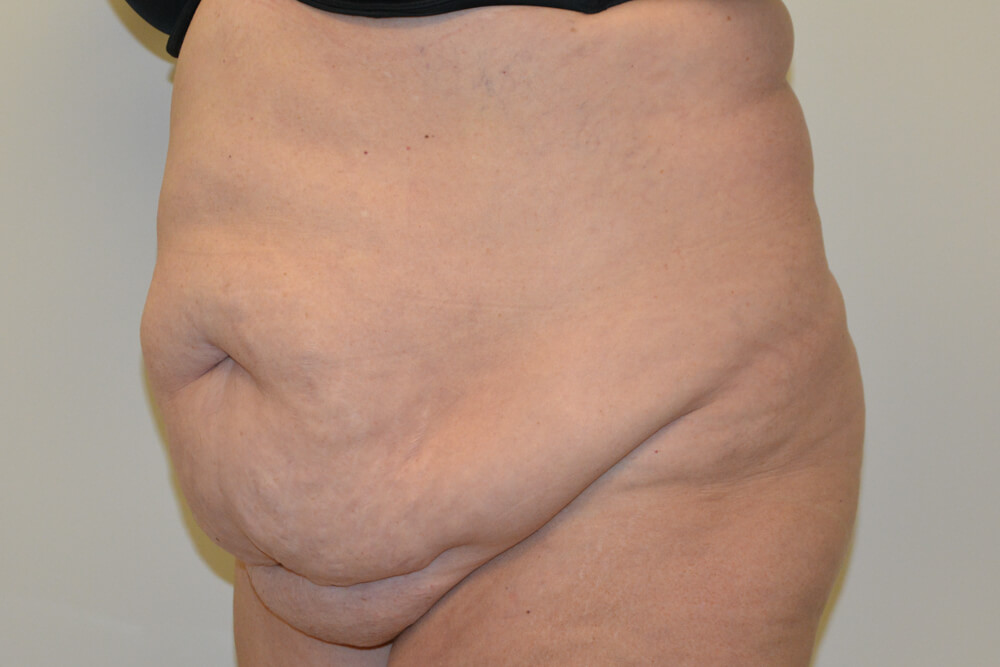 Tummy-Tuck-20 | Before Tummy Tuck 4
