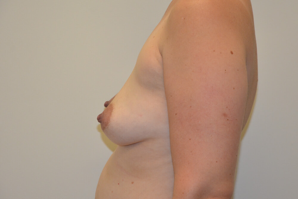 Breast-Augmentation-20 | Before Breast Augmentation 5