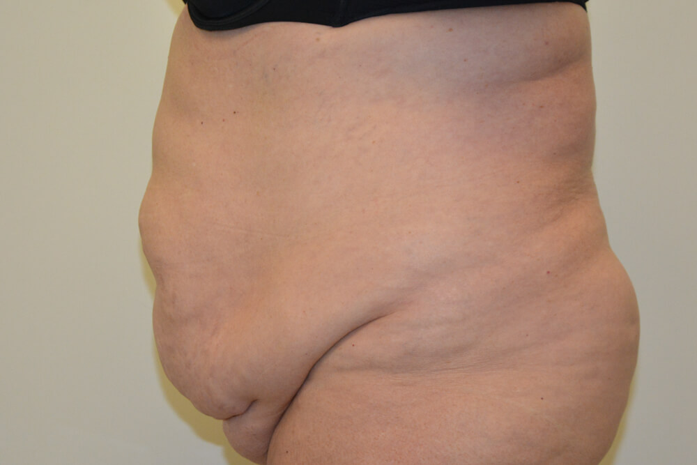 Tummy-Tuck-20 | Before Tummy Tuck 5
