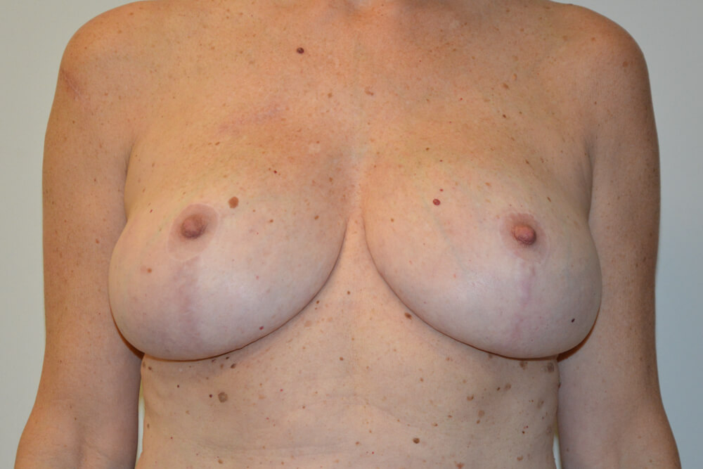 Breast-Revision-20 | After Breast Revision