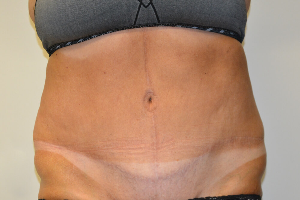 Tummy-Tuck-20 | After Tummy Tuck