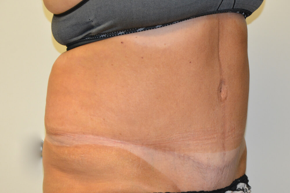 Tummy-Tuck-20 | After Tummy Tuck 2