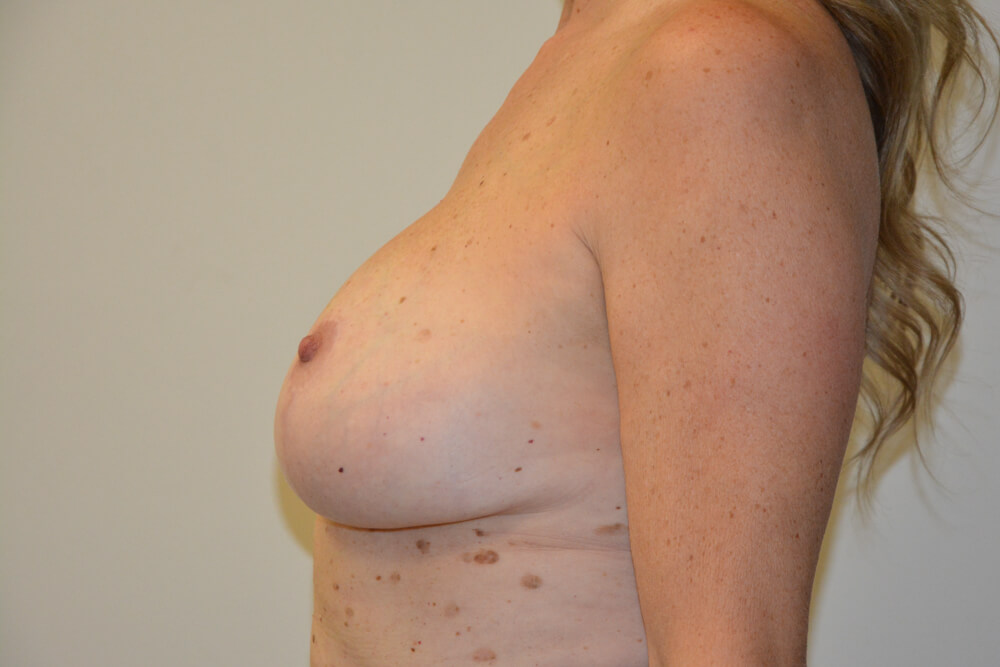 Breast-Revision-20 | After Breast Revision 3