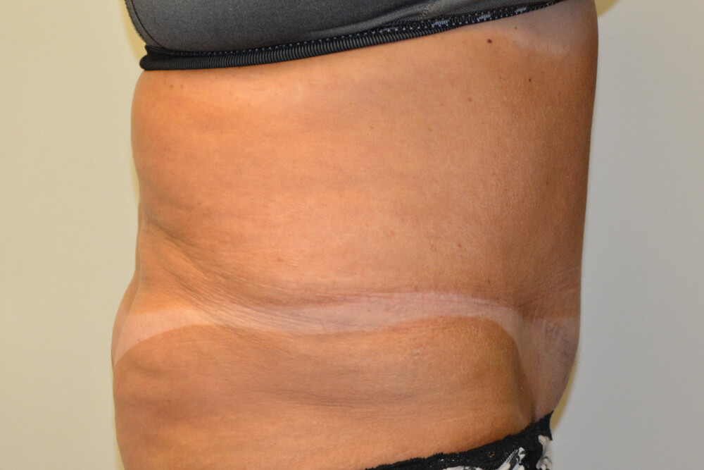 Tummy-Tuck-20 | After Tummy Tuck 3