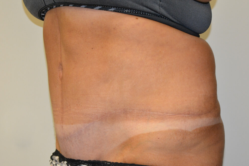 Tummy-Tuck-20 | After Tummy Tuck 4