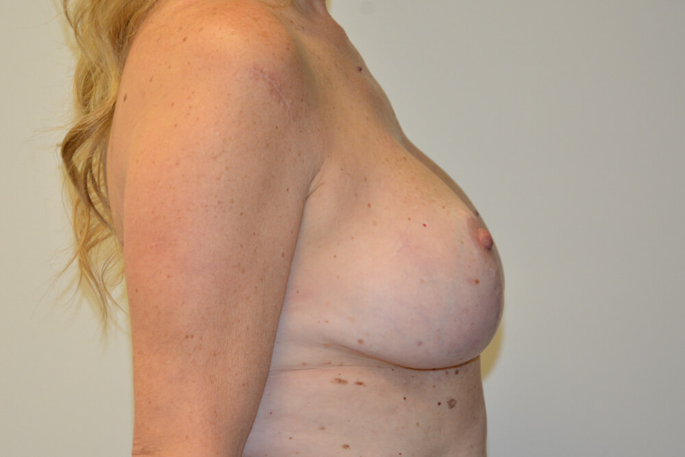Breast-Revision-20 | After Breast Revision 5