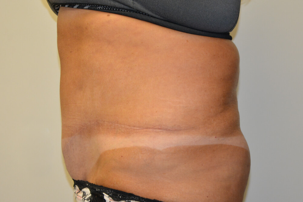 Tummy-Tuck-20 | After Tummy Tuck 5