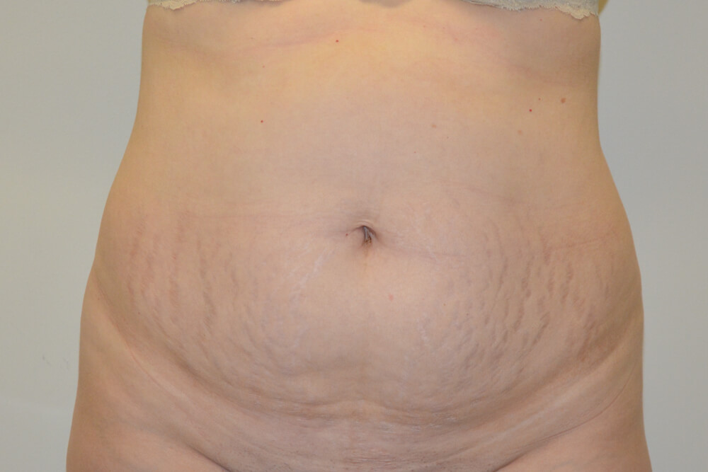 Tummy-Tuck-21 | Before Tummy Tuck