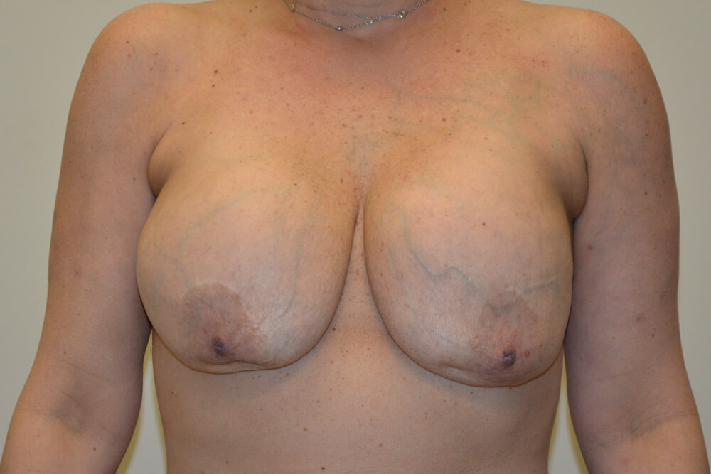 Breast-Reconstruction-Tissue-Expanders-21 | Before Breast Reconstruction Tissue Expanders