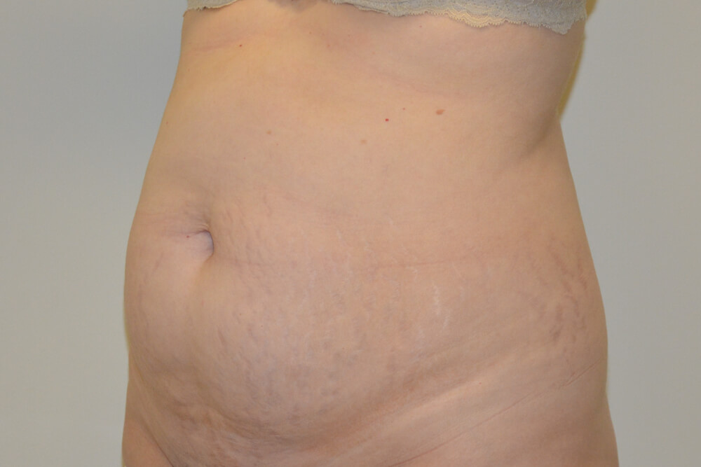 Tummy-Tuck-21 | Before Tummy Tuck 2