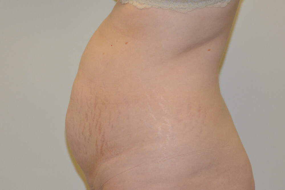 Tummy-Tuck-21 | Before Tummy Tuck 3