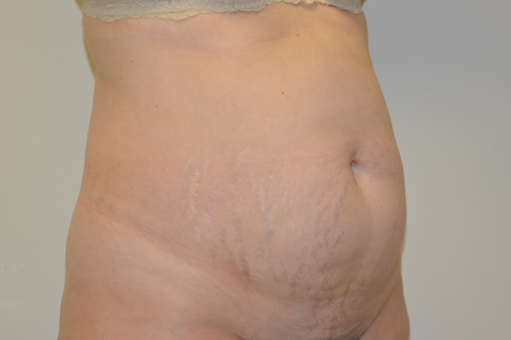 Tummy-Tuck-21 | Before Tummy Tuck 4