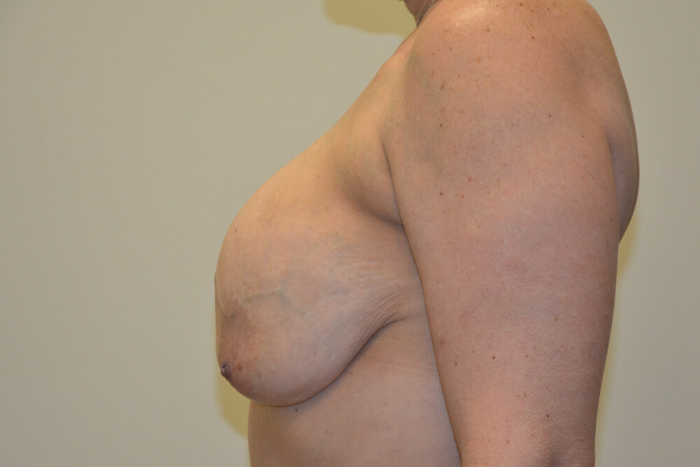 Breast-Reconstruction-Tissue-Expanders-21 | Before Breast Reconstruction Tissue Expanders 5