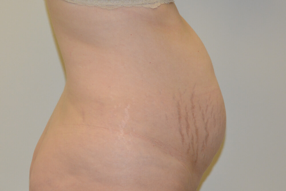 Tummy-Tuck-21 | Before Tummy Tuck 5