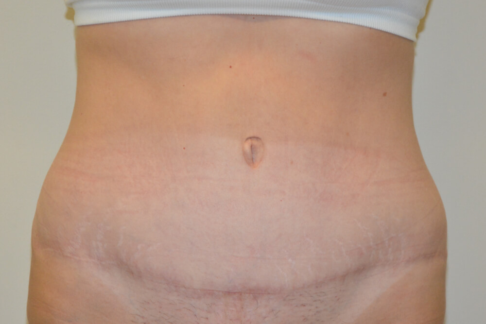 Tummy-Tuck-21 | After Tummy Tuck