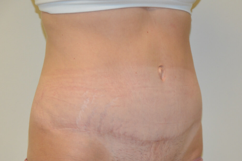 Tummy-Tuck-21 | After Tummy Tuck 4