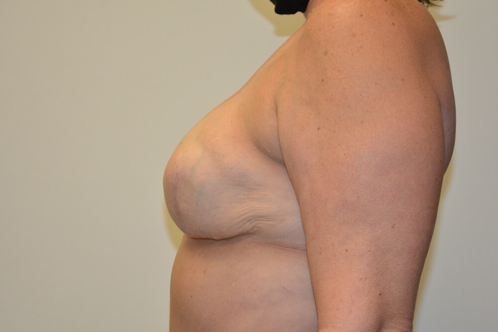 Breast-Reconstruction-Tissue-Expanders-21 | After Breast Reconstruction Tissue Expanders 5