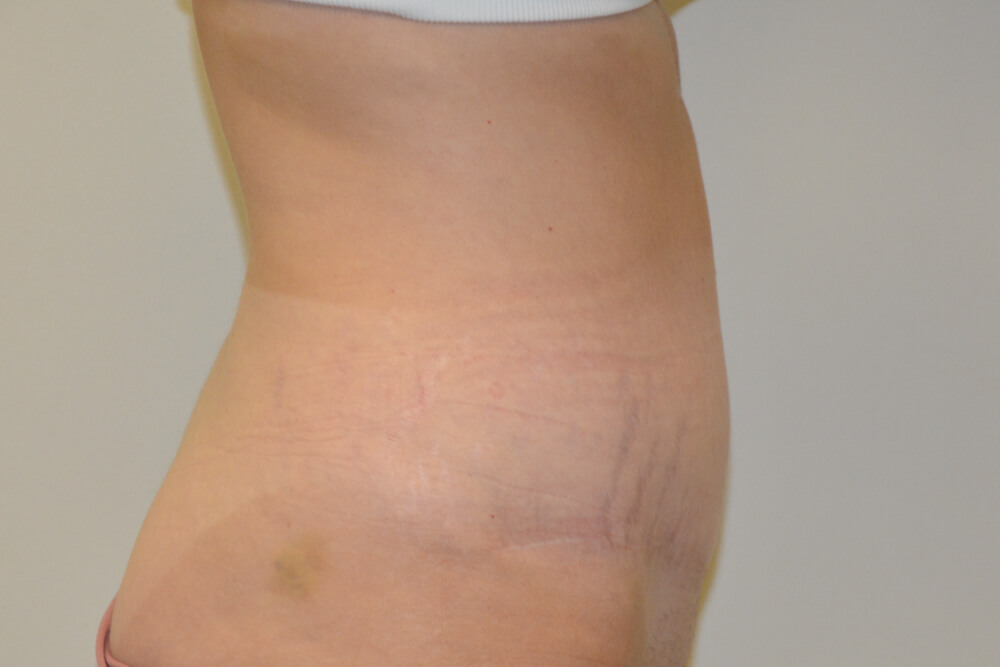 Tummy-Tuck-21 | After Tummy Tuck 5