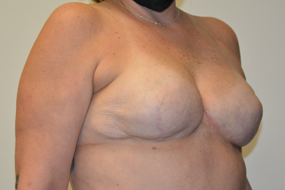 Breast-Reconstruction-Tissue-Expanders-21 | After Breast Reconstruction Tissue Expanders 2