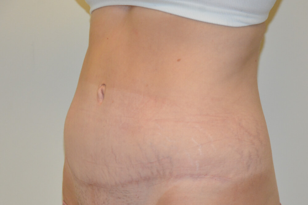 Tummy-Tuck-21 | After Tummy Tuck 2