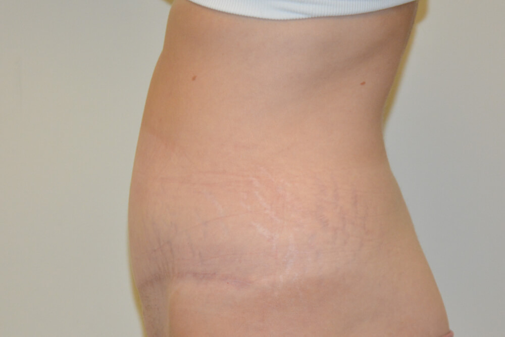Tummy-Tuck-21 | After Tummy Tuck 3
