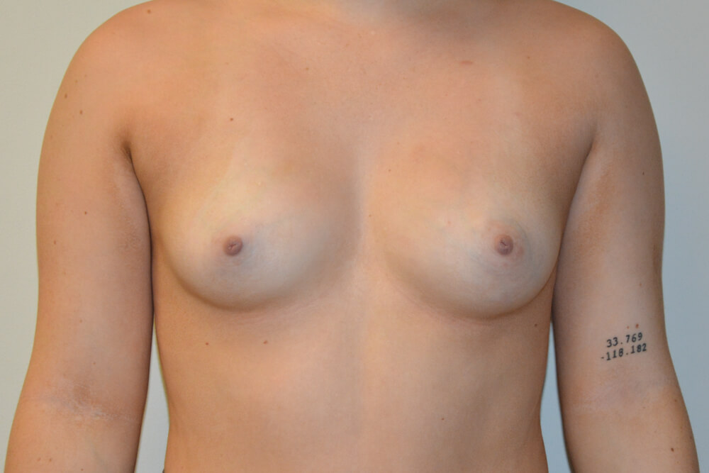 Breast-Augmentation-22 | Before Breast Augmentation