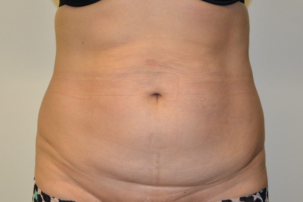 Tummy-Tuck-22 | Before Tummy Tuck