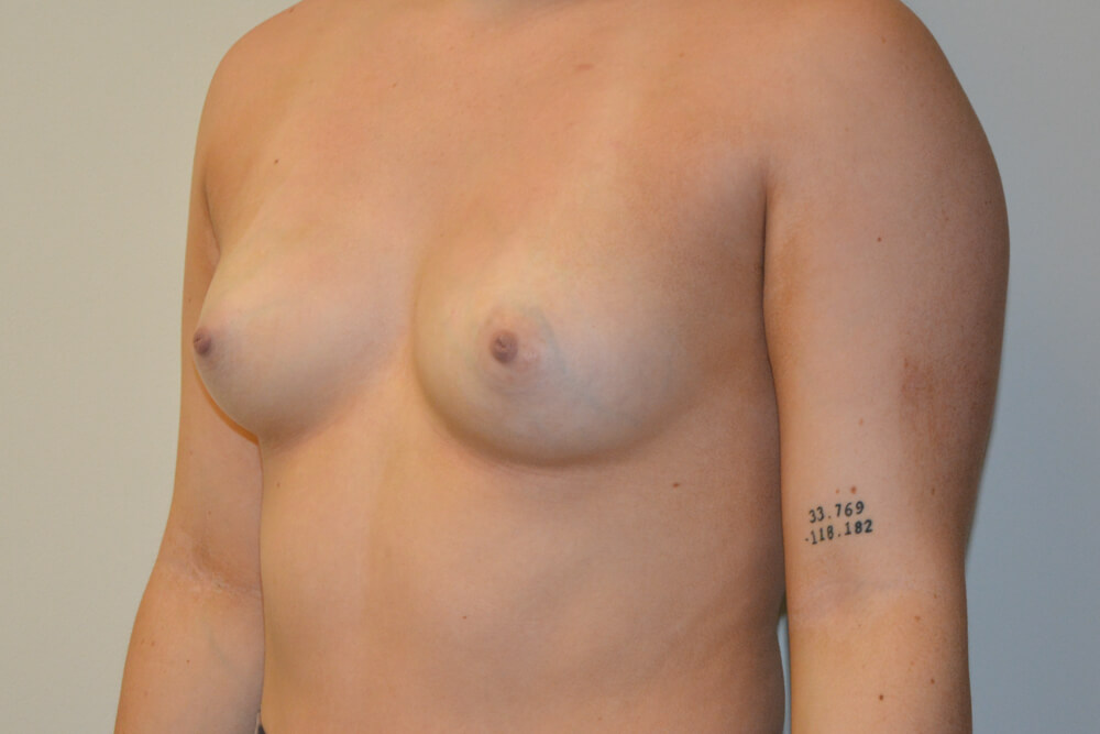 Breast-Augmentation-22 | Before Breast Augmentation 2