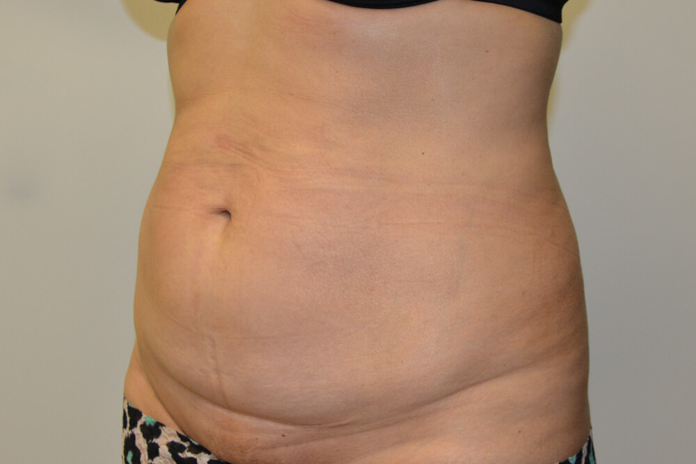 Tummy-Tuck-22 | Before Tummy Tuck 2