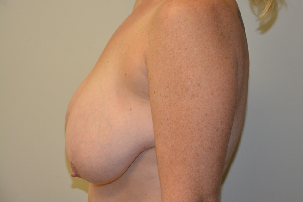 Breast-Reduction-22 | Before Breast Reduction 3