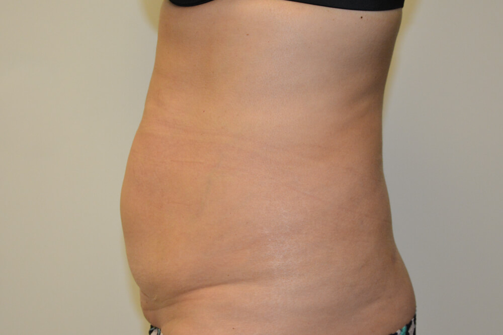 Tummy-Tuck-22 | Before Tummy Tuck 3