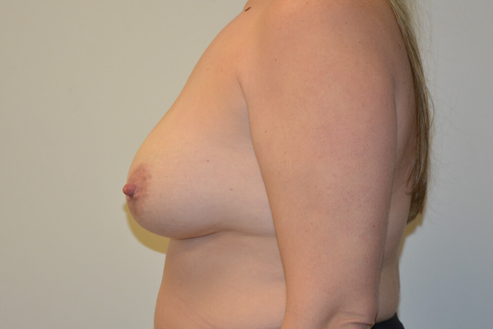 Breast-Augmentation-09 | Before Breast Augmentation 4