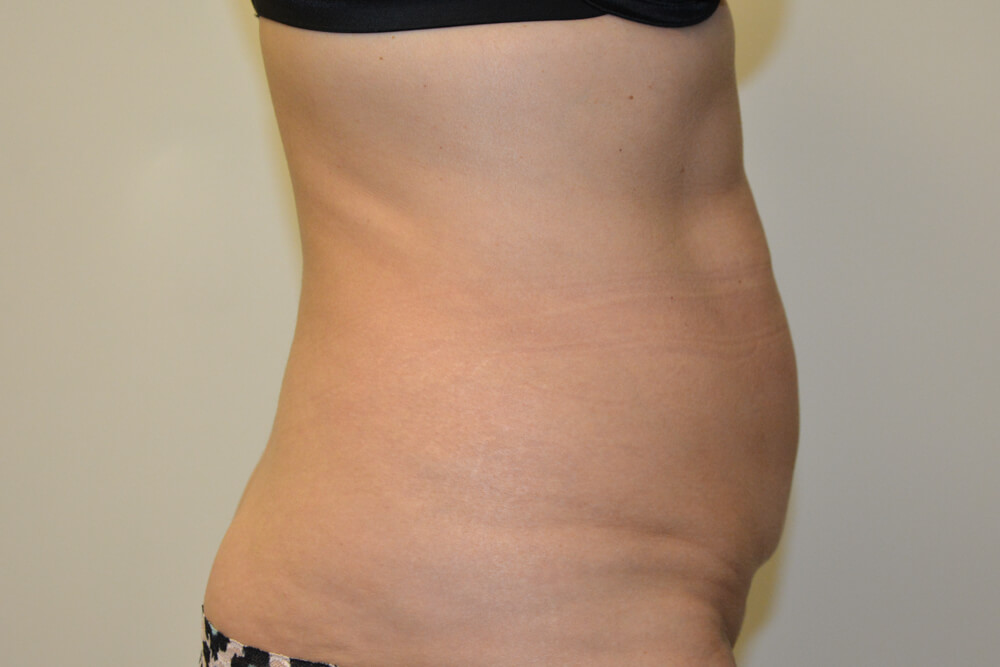 Tummy-Tuck-22 | Before Tummy Tuck 5